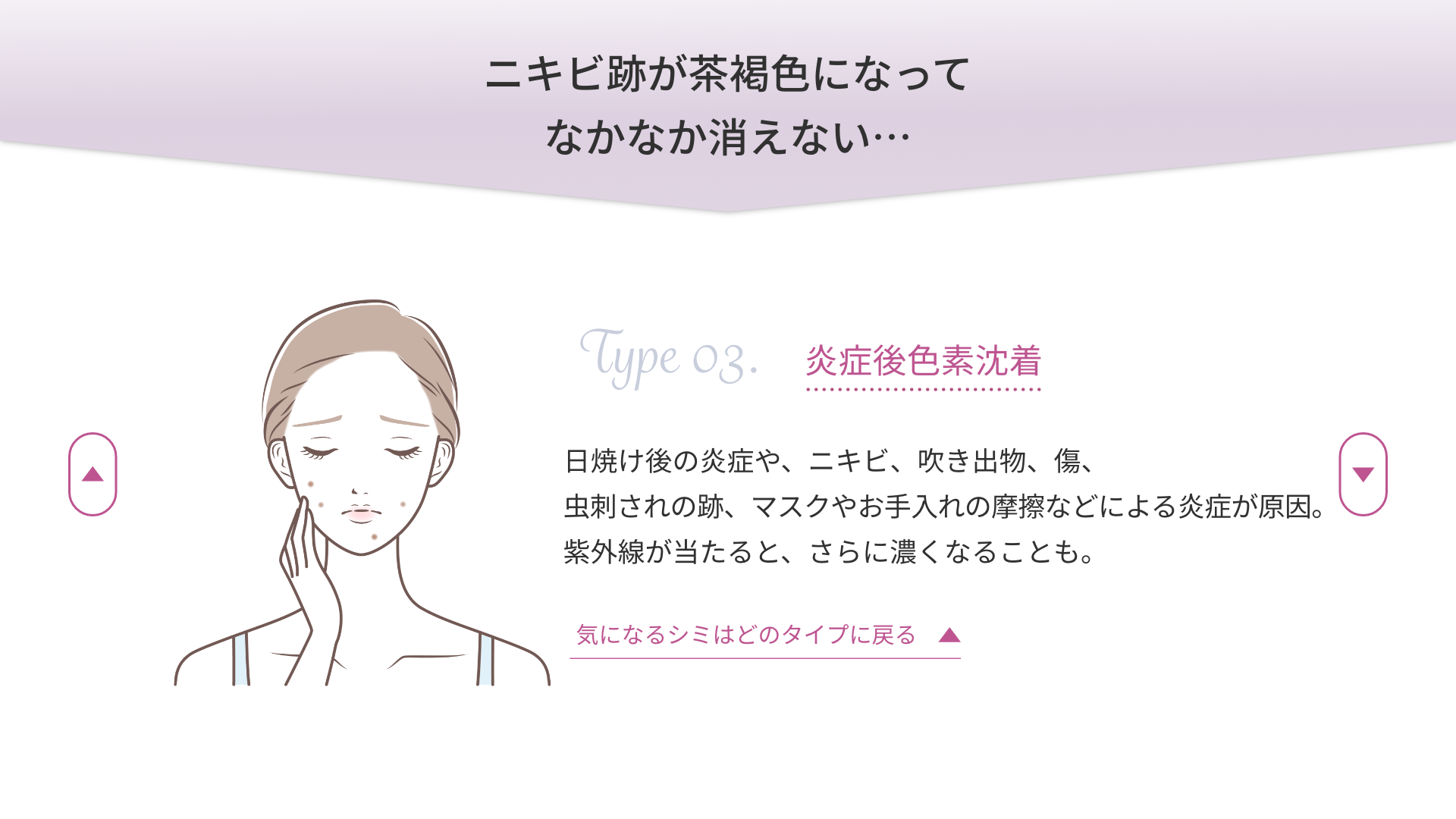 ニキビ跡が茶褐色になってなかなか消えない…「炎症後色素沈着」